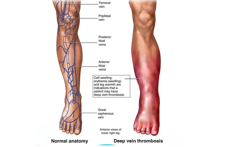 varicose_veins_content_image