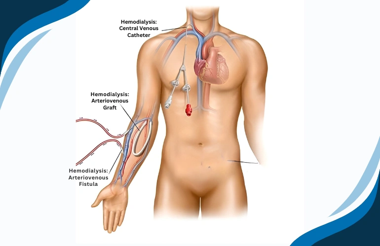 Best_AVFistula_vs_PermCath_Treatment_in_hyderabad