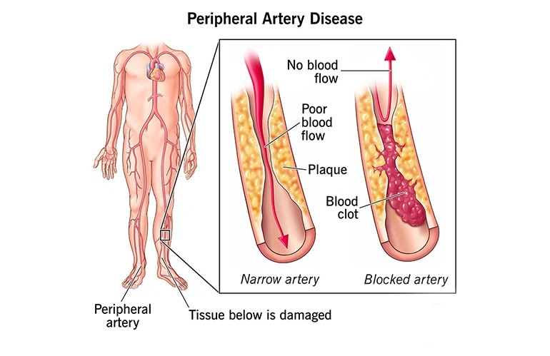 peripheral_artery
