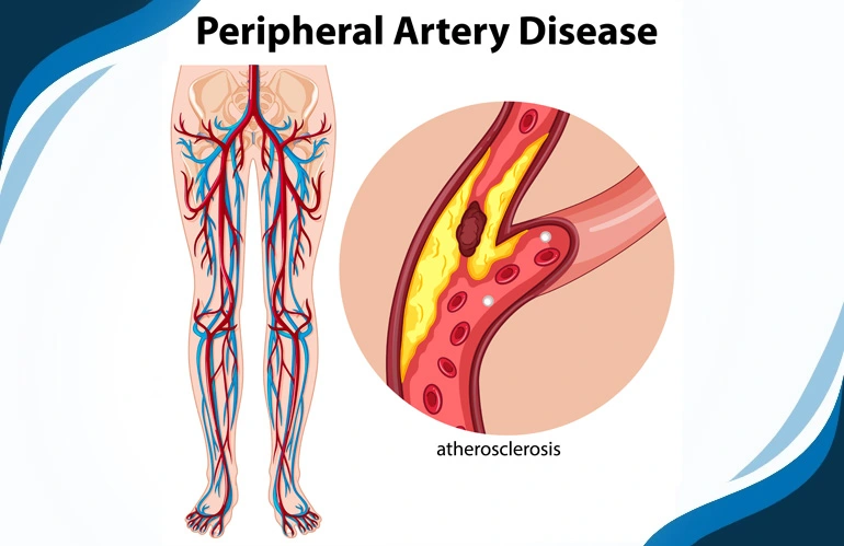 peripheral_artery_occlusive_disease_content_image_one_stop_vascular_solutionsgh