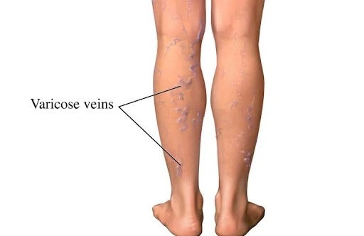 varicose_veins_content_image
