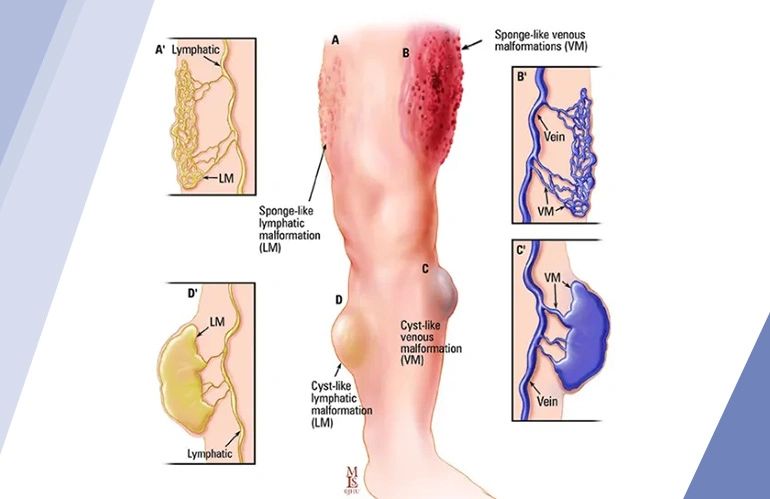 varicose_veins_content_image